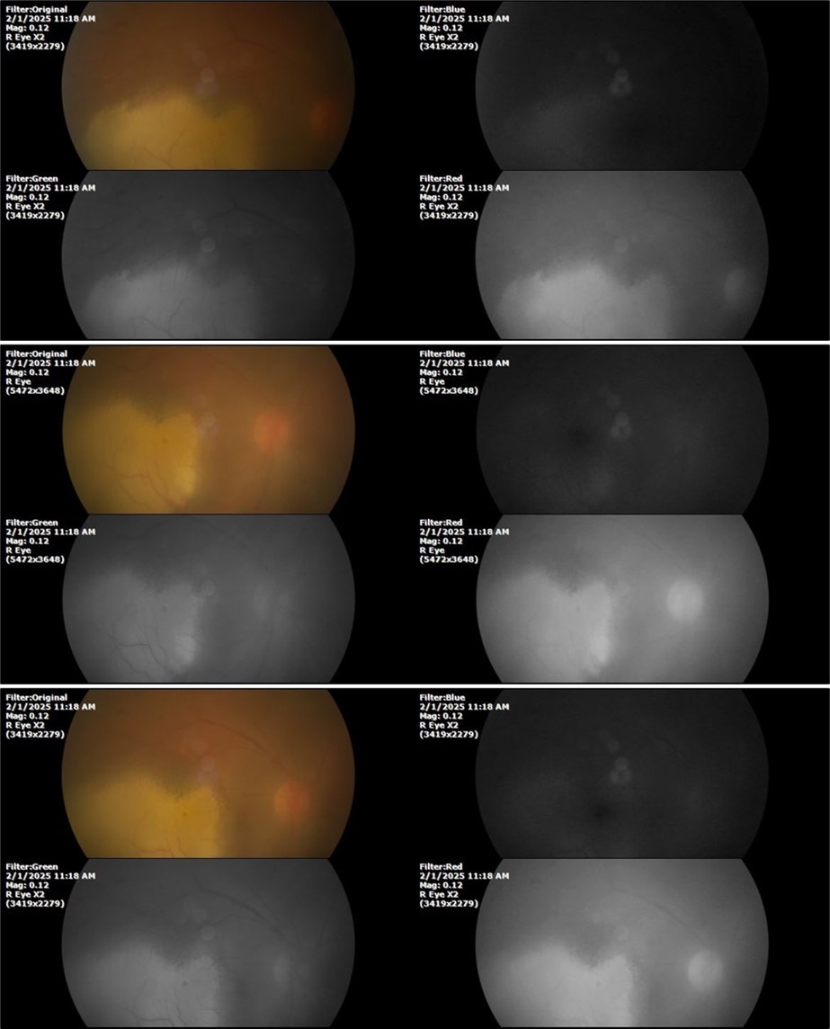 Journal of Aging Research and Healthcare - Berlin´s edema