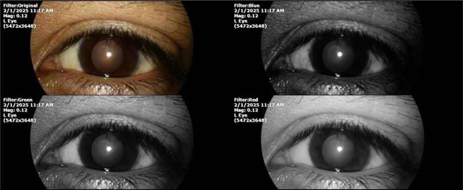 Journal of Aging Research and Healthcare - Berlin´s edema