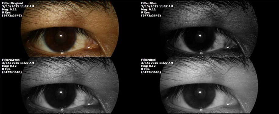Journal of Aging Research and Healthcare - Berlin´s edema
