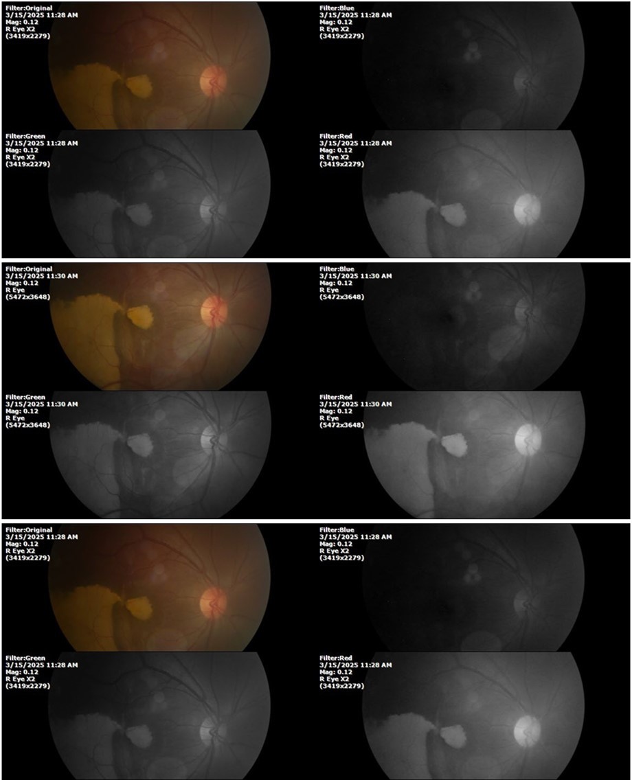 Journal of Aging Research and Healthcare - Berlin´s edema