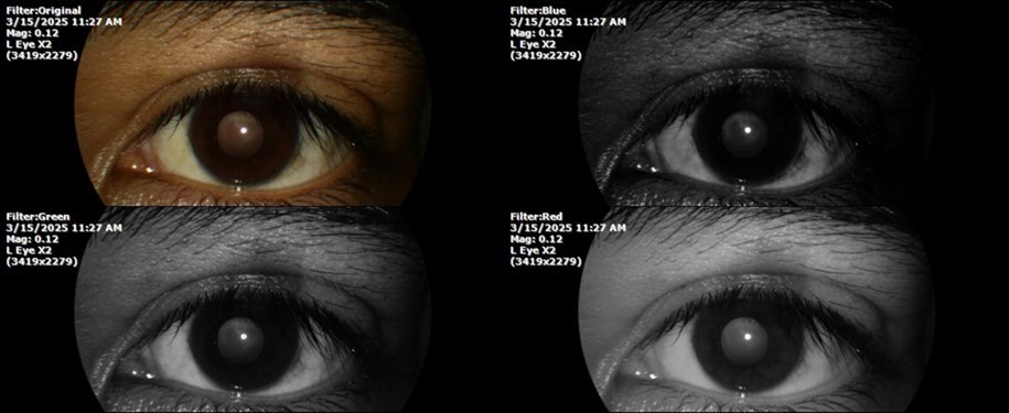 Journal of Aging Research and Healthcare - Berlin´s edema