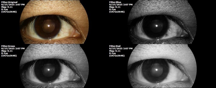Journal of Aging Research and Healthcare - Berlin´s edema