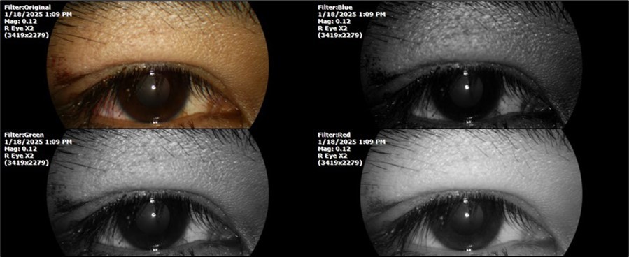 Journal of Aging Research and Healthcare - Berlin´s edema