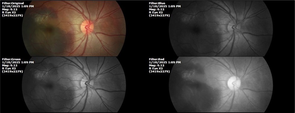 Journal of Aging Research and Healthcare - Berlin´s edema