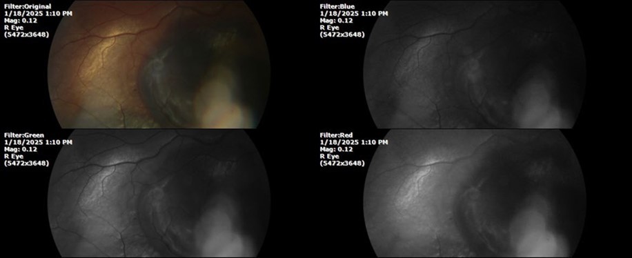 Journal of Aging Research and Healthcare - Berlin´s edema