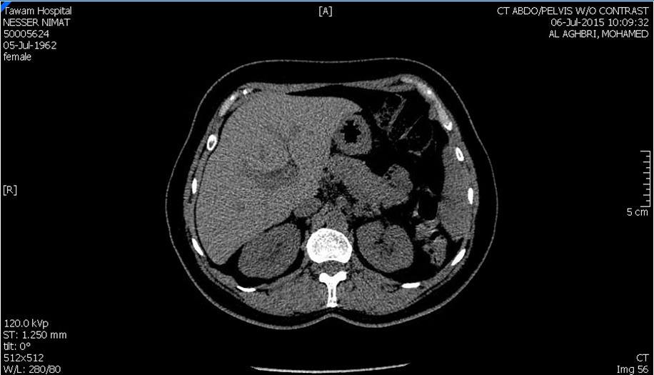 Journal of Nephrology Advances-Dapagliflozin