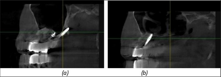 Journal of Dentistry and Oral Implants - Periimplantitis