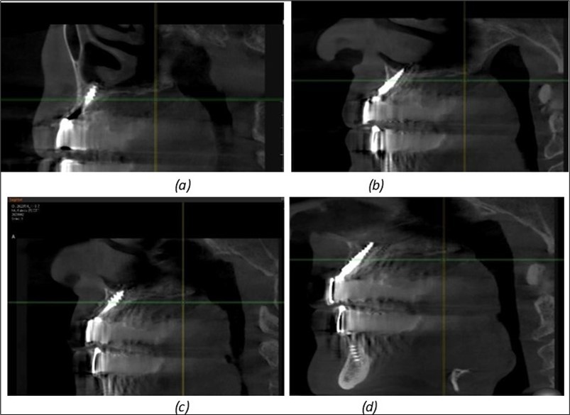 Journal of Dentistry and Oral Implants - Periimplantitis