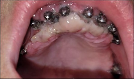 Journal of Dentistry and Oral Implants - Periimplantitis