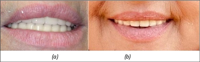 Journal of Dentistry and Oral Implants - Periimplantitis