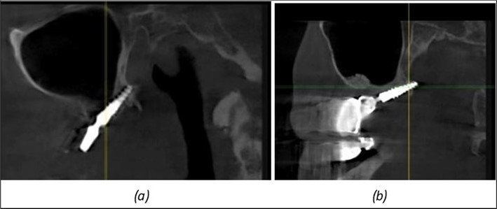 Journal of Dentistry and Oral Implants - Periimplantitis