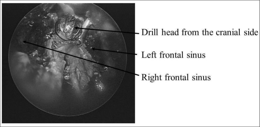 Journal of Otolaryngology Advances-CT