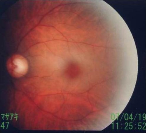 Journal of Otolaryngology Advances-CT