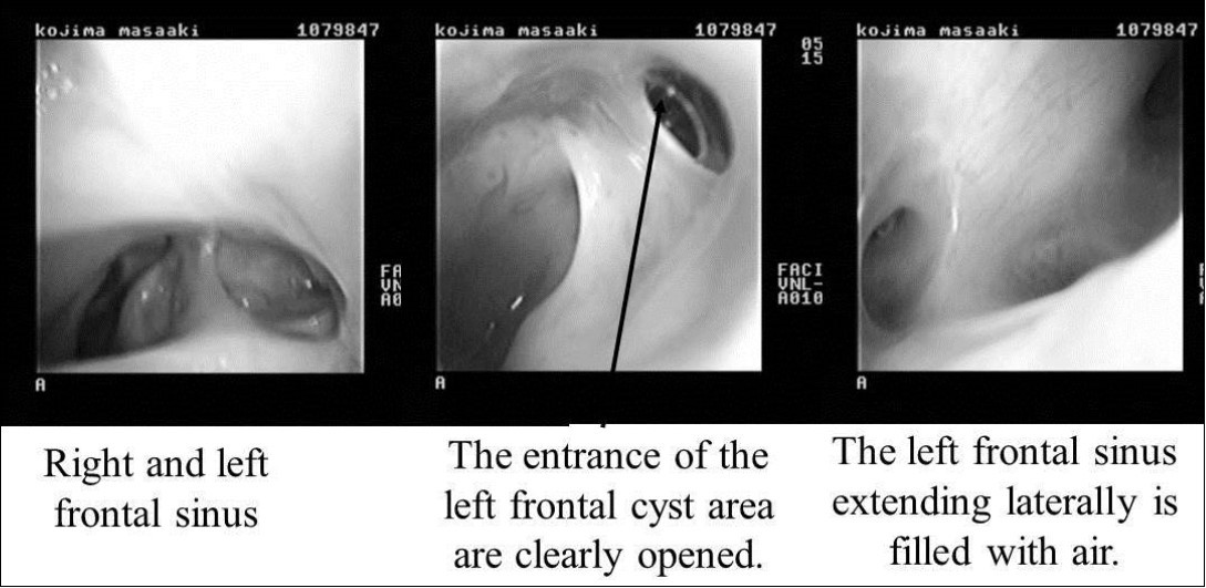 Journal of Otolaryngology Advances-CT