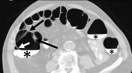 Journal Of Colon And Rectal Cancer-Haustral Fold Heights