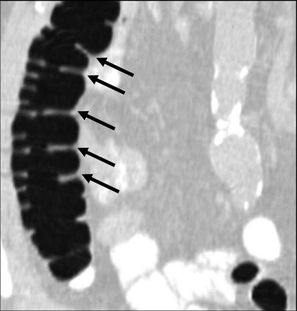 Journal Of Colon And Rectal Cancer-Haustral Fold Heights