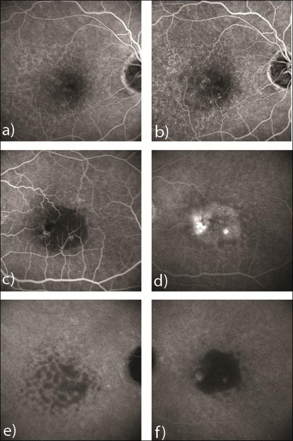 Journal Of Ophthalmic Science-drusen