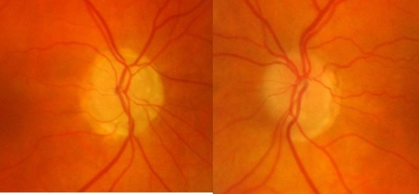 Journal of Ophthalmic Science-Optic nerve head drusen