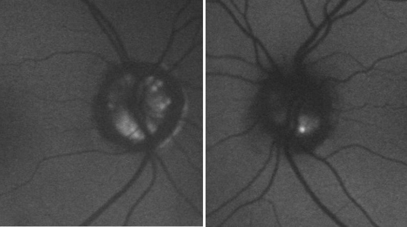 Journal of Ophthalmic Science-Optic nerve head drusen