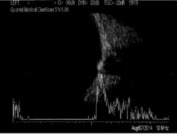 Journal of Ophthalmic Science-Optic nerve head drusen