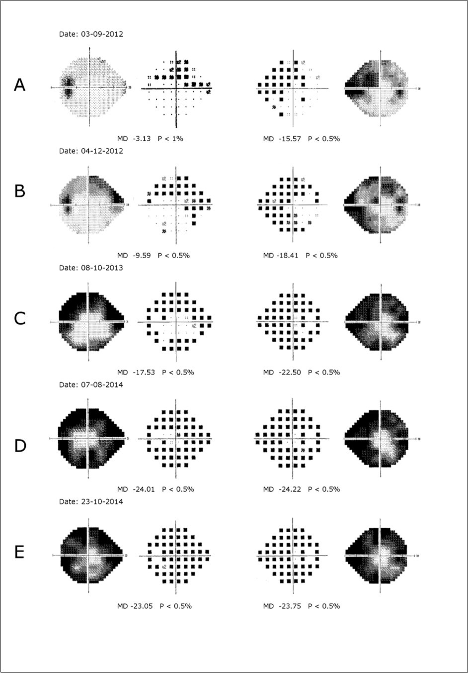 Journal of Ophthalmic Science-Optic nerve head drusen