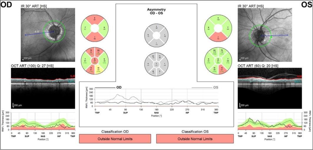 Journal of Ophthalmic Science-Optic nerve head drusen