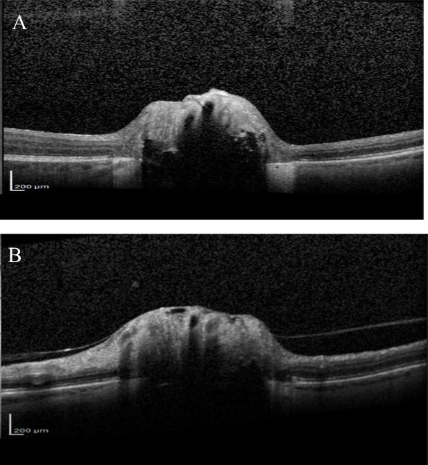 Journal of Ophthalmic Science-Optic nerve head drusen
