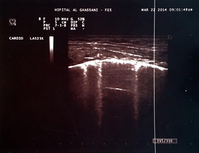 Journal of Nephrology Advances-Ultrasound lung