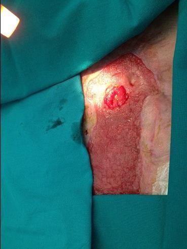 Journal Of Colon And Rectal Cancer-cardiac septal occluder