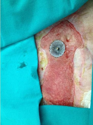 Journal Of Colon And Rectal Cancer-cardiac septal occluder