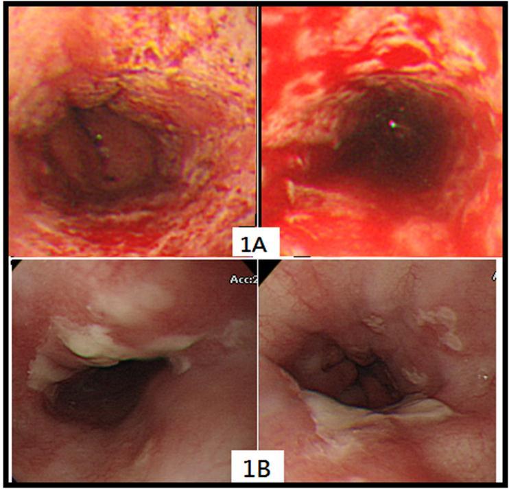 Journal of Digestive Disorders and Diagnosis-Cytomegalovirus