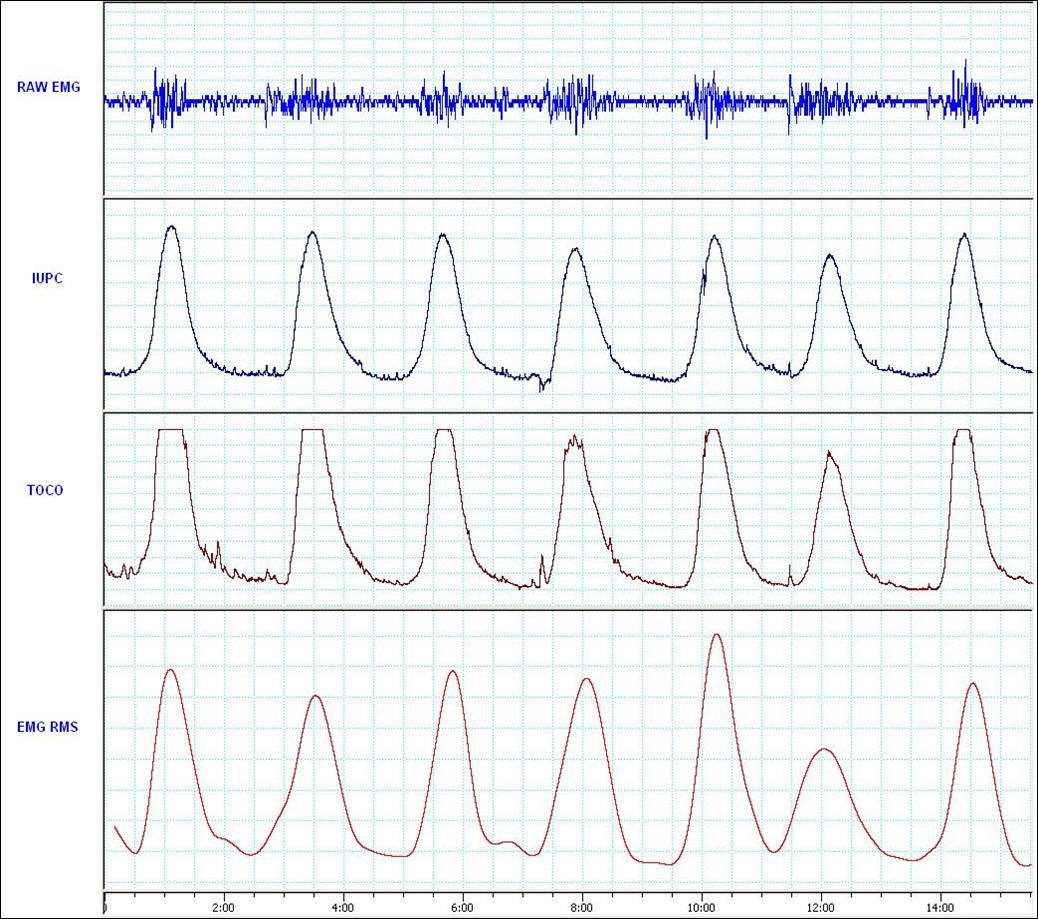 Journal Of Woman's Reproductive Health-contraction peak time