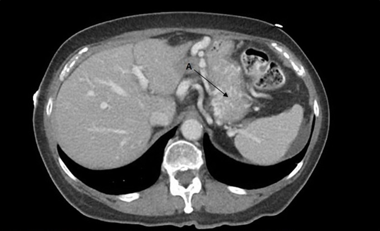 Journal of Digestive Disorders and Diagnosis-Left gastric vein