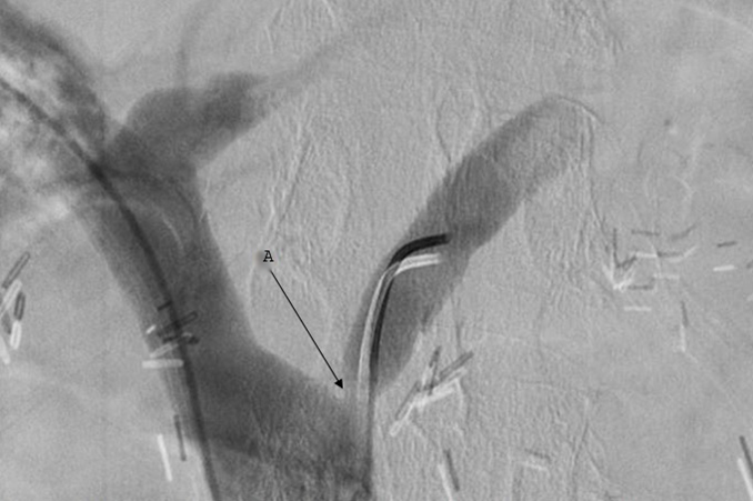 Journal of Digestive Disorders and Diagnosis-Left gastric vein