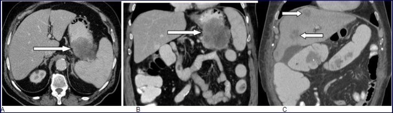 Journal Of Digestive Disorders And Diagnosis-adenocarcinoma