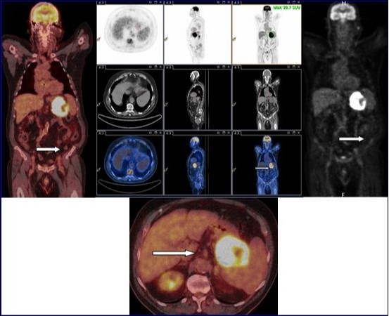Journal Of Digestive Disorders And Diagnosis-adenocarcinoma