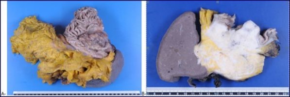 Journal Of Digestive Disorders And Diagnosis-adenocarcinoma