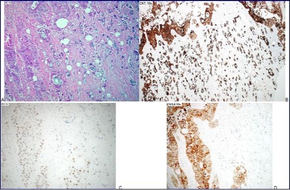 Journal Of Digestive Disorders And Diagnosis-adenocarcinoma