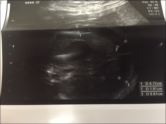 Journal of Fetal Surgery-Congenital Pulmonary airway malformation (CPAM)