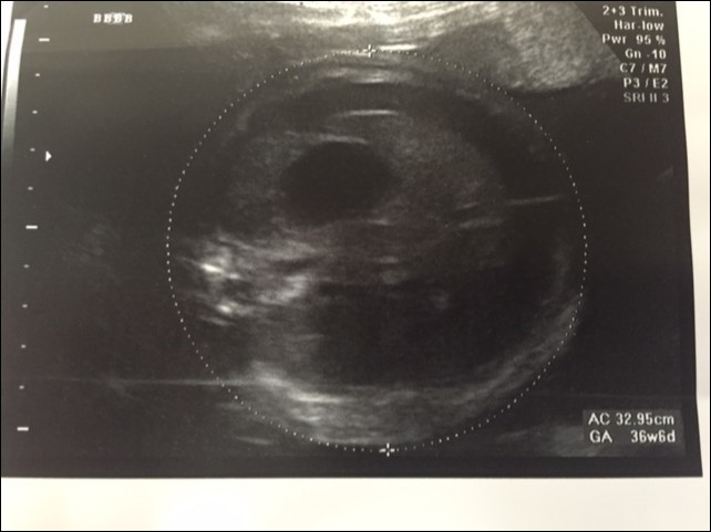 Journal of Fetal Surgery-Congenital Pulmonary airway malformation (CPAM)