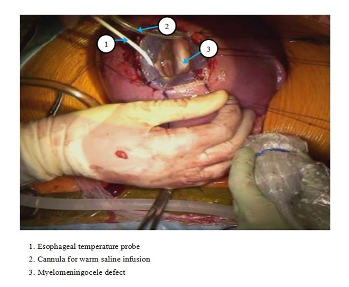 Journal of Fetal Surgery-Congenital Pulmonary airway malformation (CPAM)