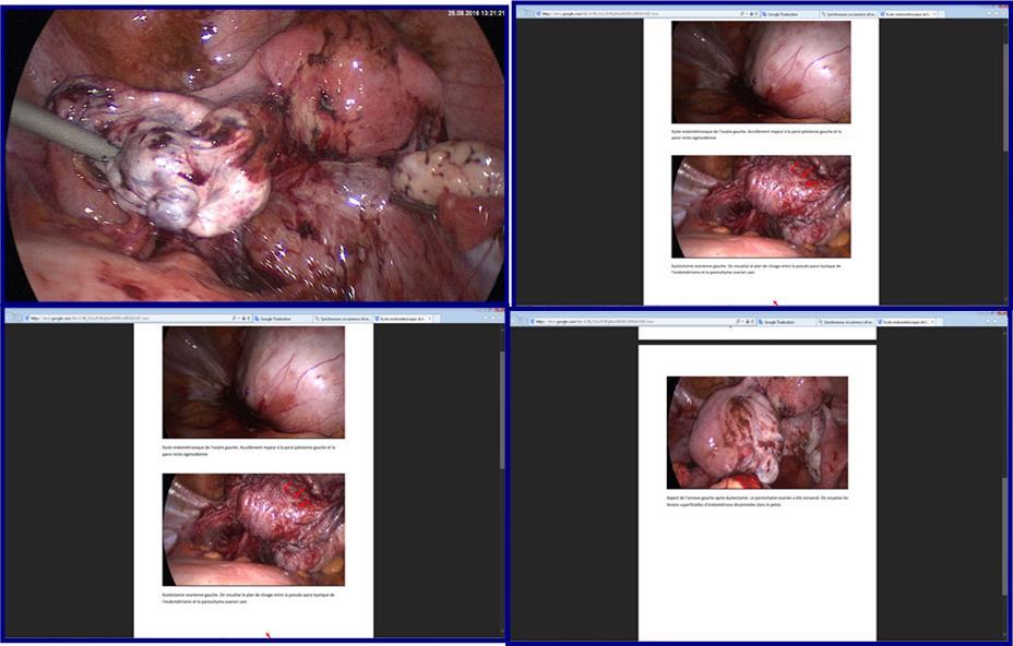 Surgical finding showing (a, b) left ovarian cystectomy. We visualize the cleavage plane between the pseudo-cyst wall of endometria and the healthy ovarian parenchyma. (c) Appearance of left remaining adenexa after cystectomy. (d) Ovarian parenchyma was preserved.