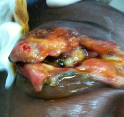 Journal Of Clinical Research in HIV AIDS and Prevention-squamous cell