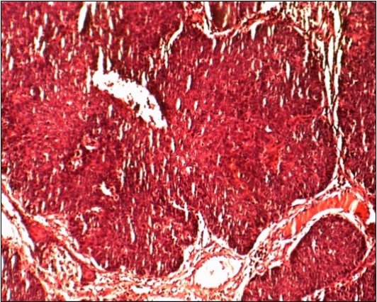 Journal Of Clinical Research in HIV AIDS and Prevention-squamous cell