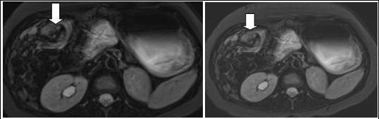Journal of Digestive Disorders and Diagnosis-Small Bowel Obstruction