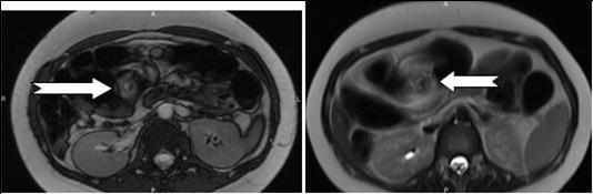 Journal of Digestive Disorders and Diagnosis-Small Bowel Obstruction