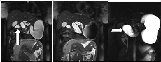 Journal of Digestive Disorders and Diagnosis-Small Bowel Obstruction
