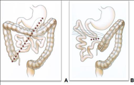 Journal of Digestive Disorders and Diagnosis-Small Bowel Obstruction