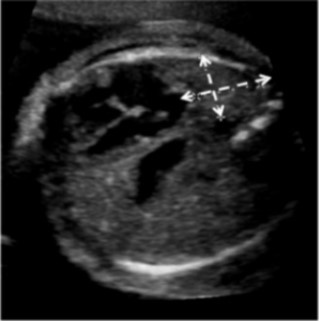 Fetal ultrasound demonstrating apropriate measurement of lung at the four-chamber view of the heart