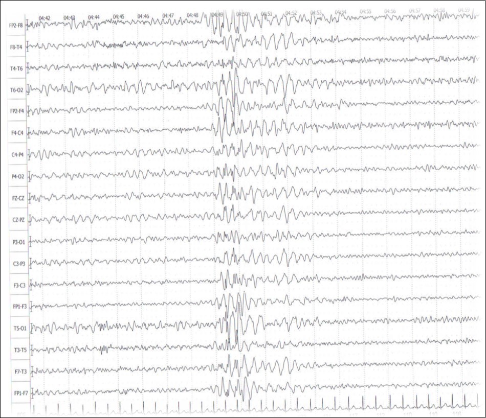 Electroencephalograms (EEG) Sleep records showed brief discharges of generalized slow spikes or spike waves